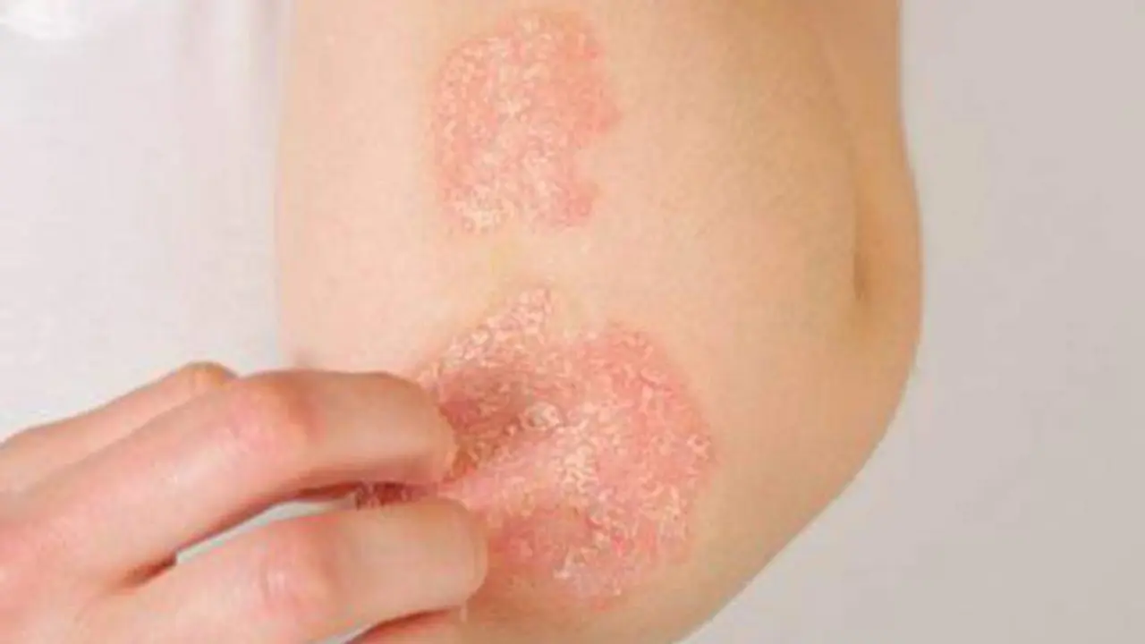  Dermat&oacute;logos andaluces publican un manual digital de casos cl&iacute;nicos de psoriasis 