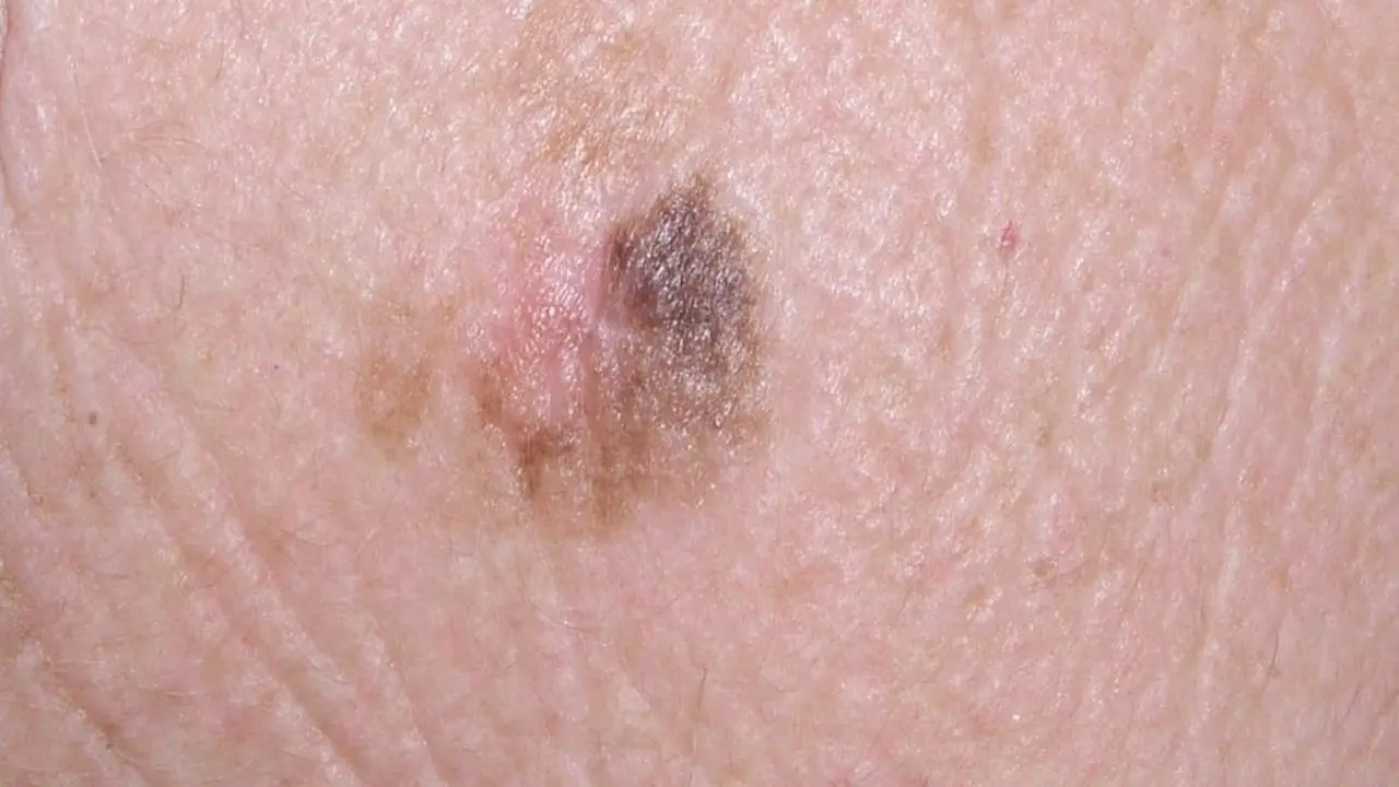  Archivo - Melanoma - EUROPEAN ASSOCIATION OF DERMATO 