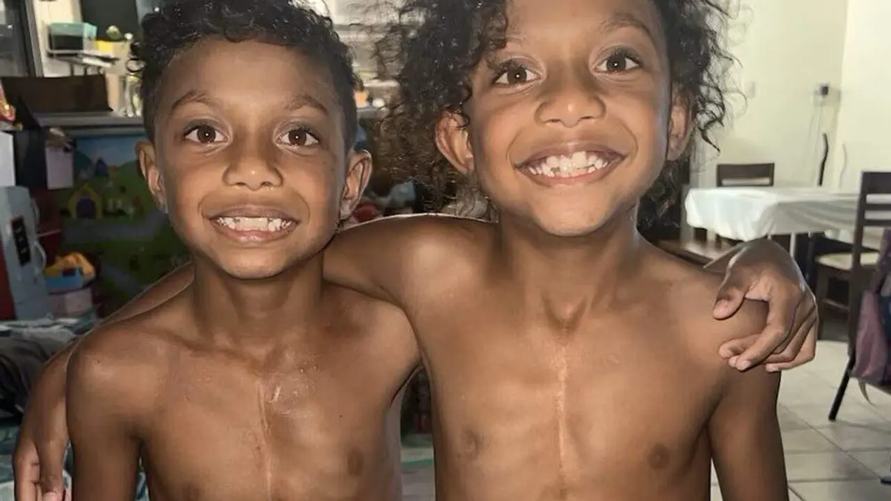  gemelos operados a coraz&oacute;n abierto 