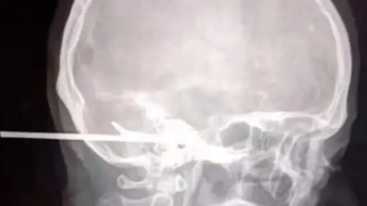 Radiograf&iacute;a del cr&aacute;neo atravesado con un arp&oacute;n - 20 minutos 