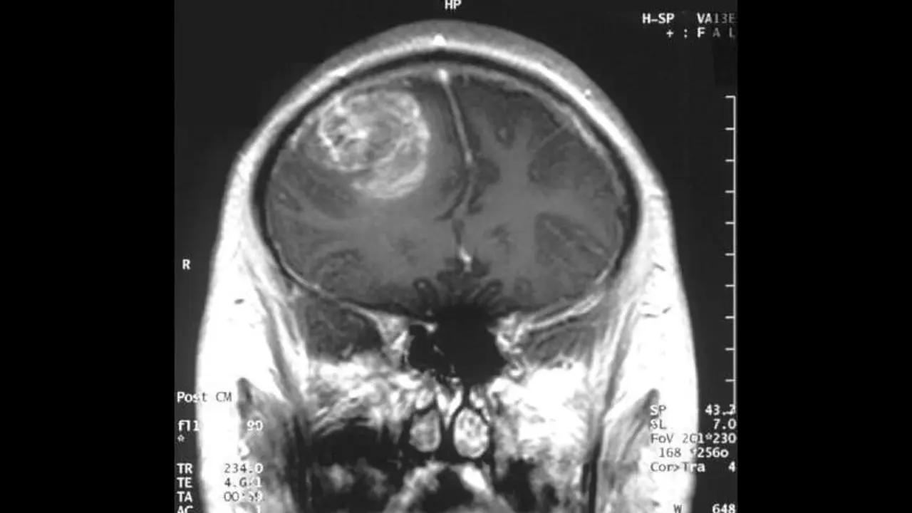  C&aacute;ncer cerebral 