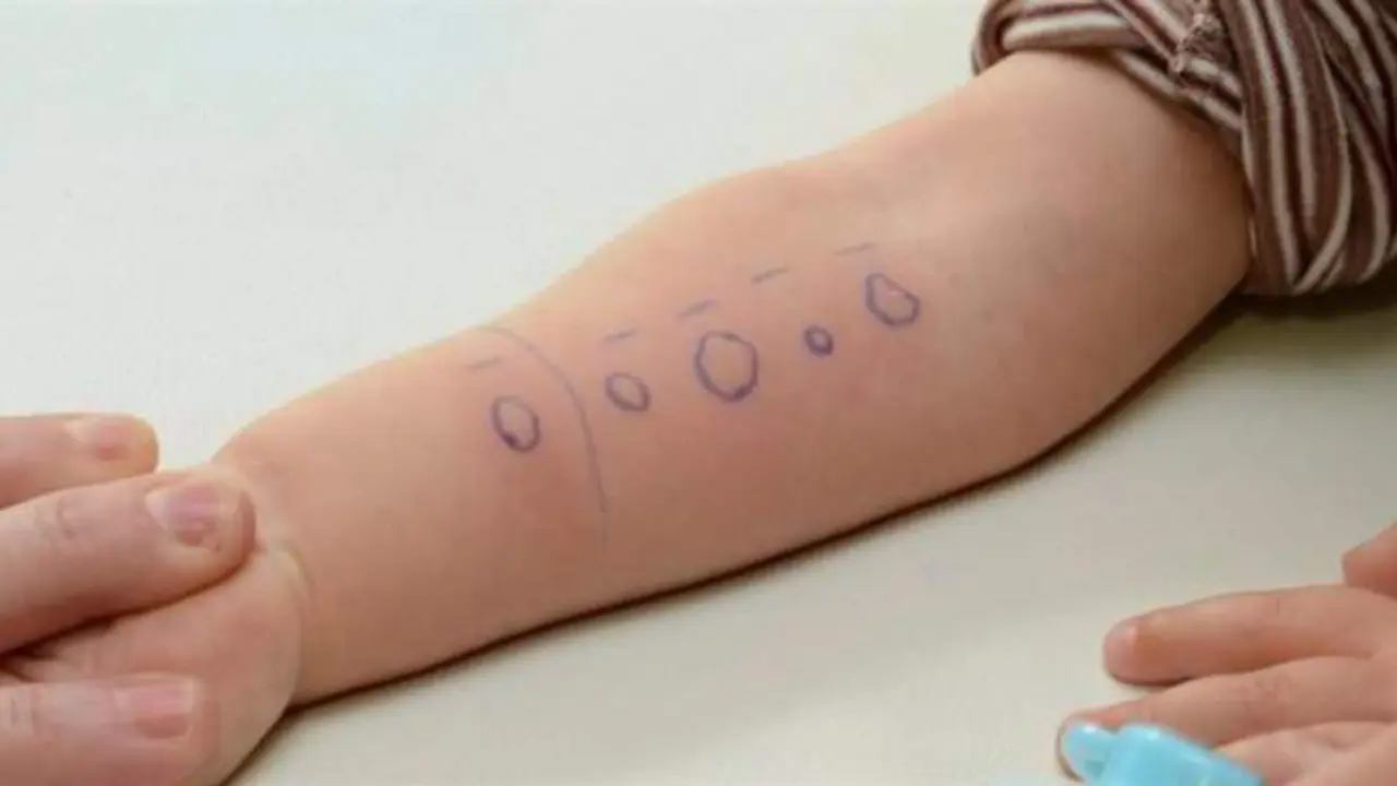  El 80% de los menores con TDAH tiene una mayor probabilidad de sufrir alergias 