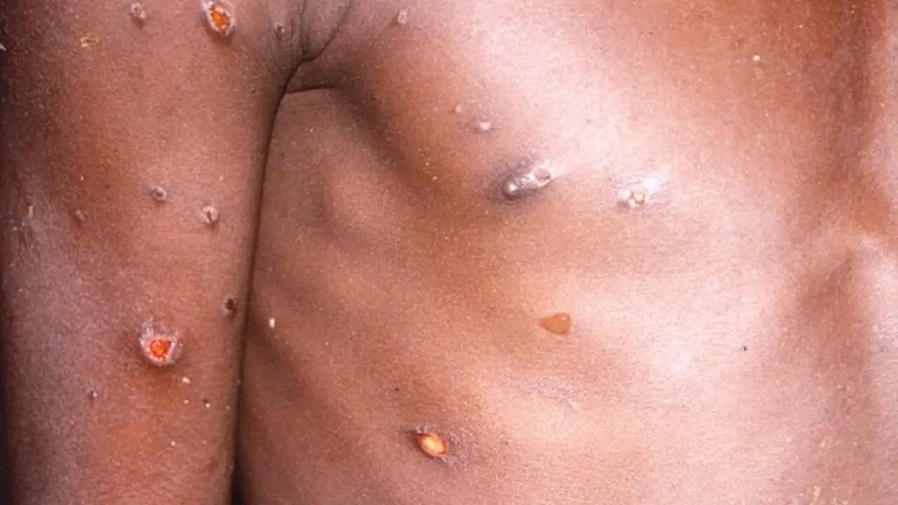  Archivo - La viruela del mono produce lesiones cut&aacute;neas, fiebre y dolor corporal en las personas afectadas por el virus. - CDC - Archivo 