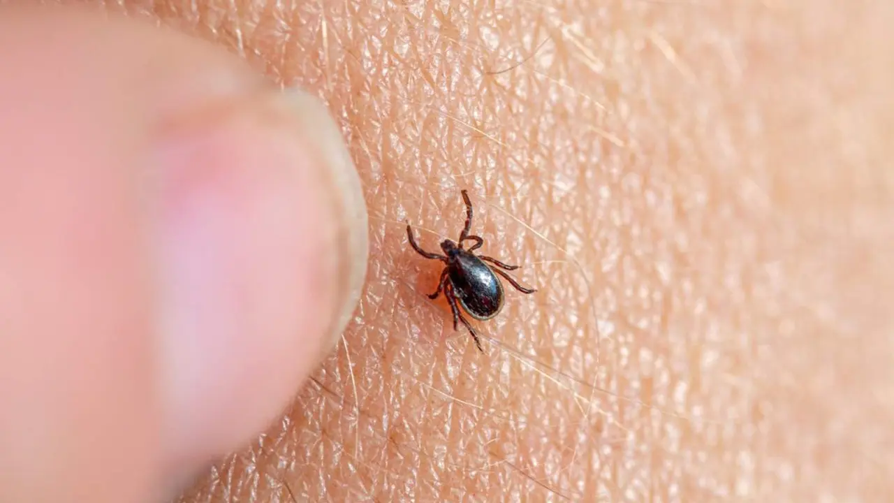  Archivo - Imagen de una garrapata marr&oacute;n en la piel humana con un dedo femenino a punto de retirarla. - FUNDACI&Oacute;N SOS LYME - Archivo 