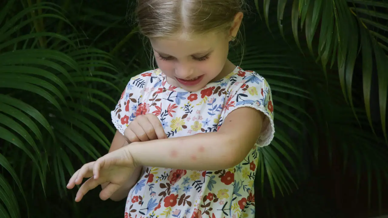  Picaduras en ni&ntilde;os 