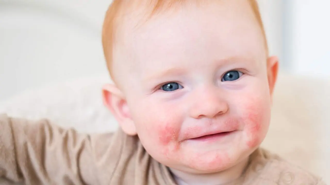  Dermatitis at&oacute;pica 