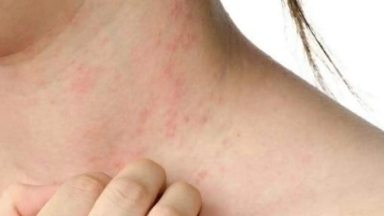  Dermatitis Atópica 