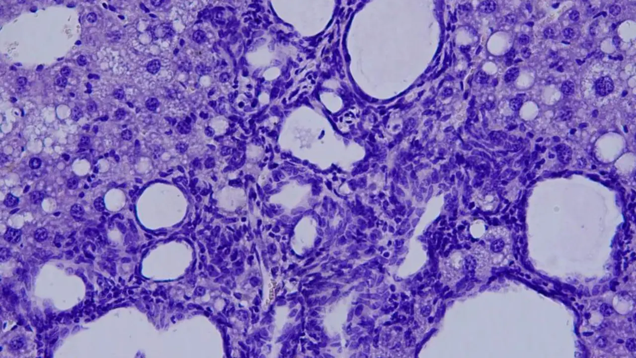  Archivo - Colangiocarcinoma visto al microscopio. - CNIC - Archivo 