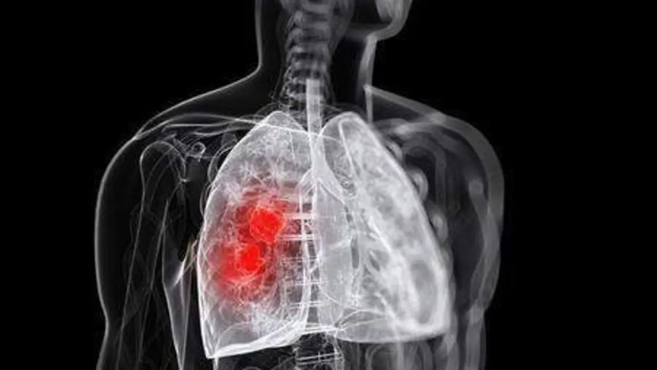  Ilustraci&oacute;n de esqueleto con dificultades en el pulm&oacute;n. Pinterest. 