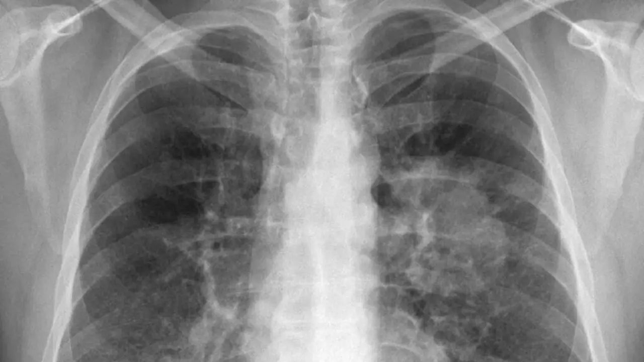  Radiograf&iacute;a de un c&aacute;ncer de pulm&oacute;n 