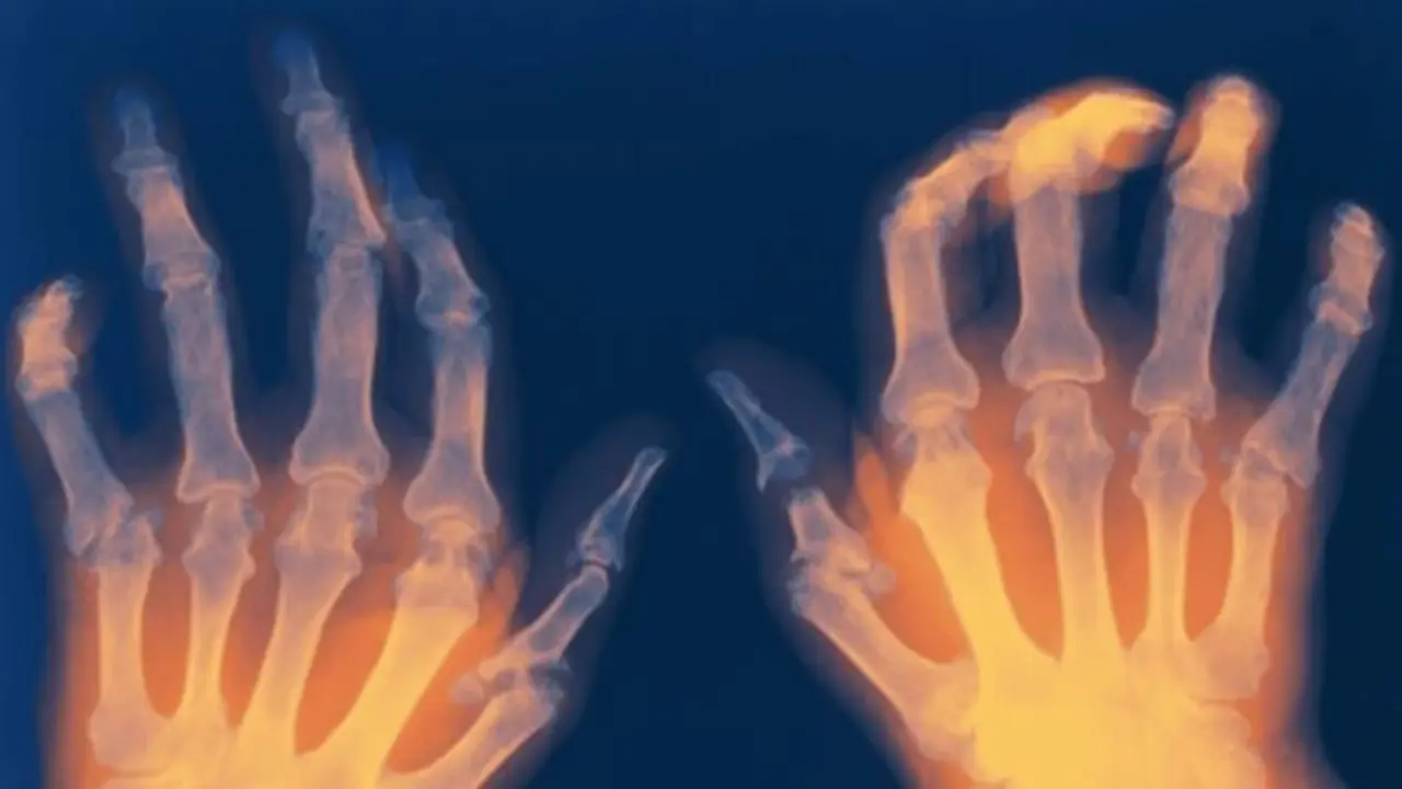  Reumat&oacute;loga resalta avances en artritis reum&aacute;tica y menor mortalidad 