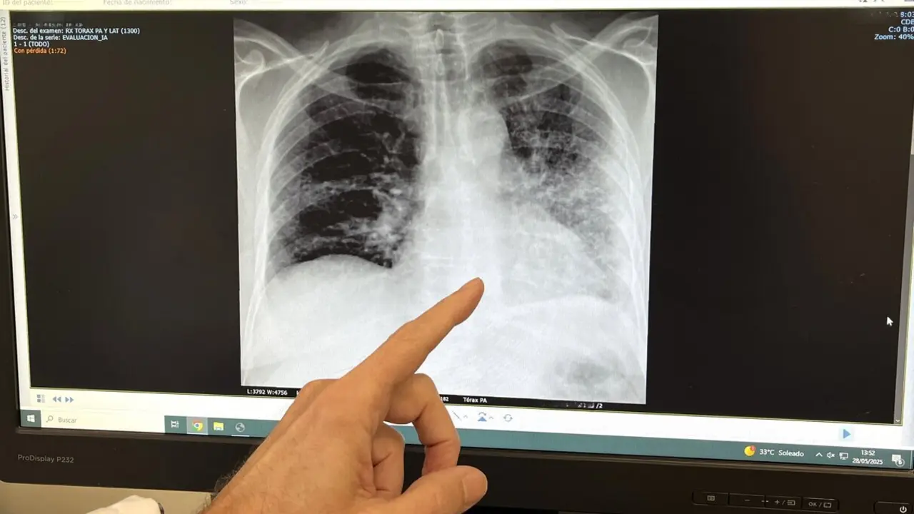  RX de paciente fumador con c&aacute;ncer de pulm&oacute;n 