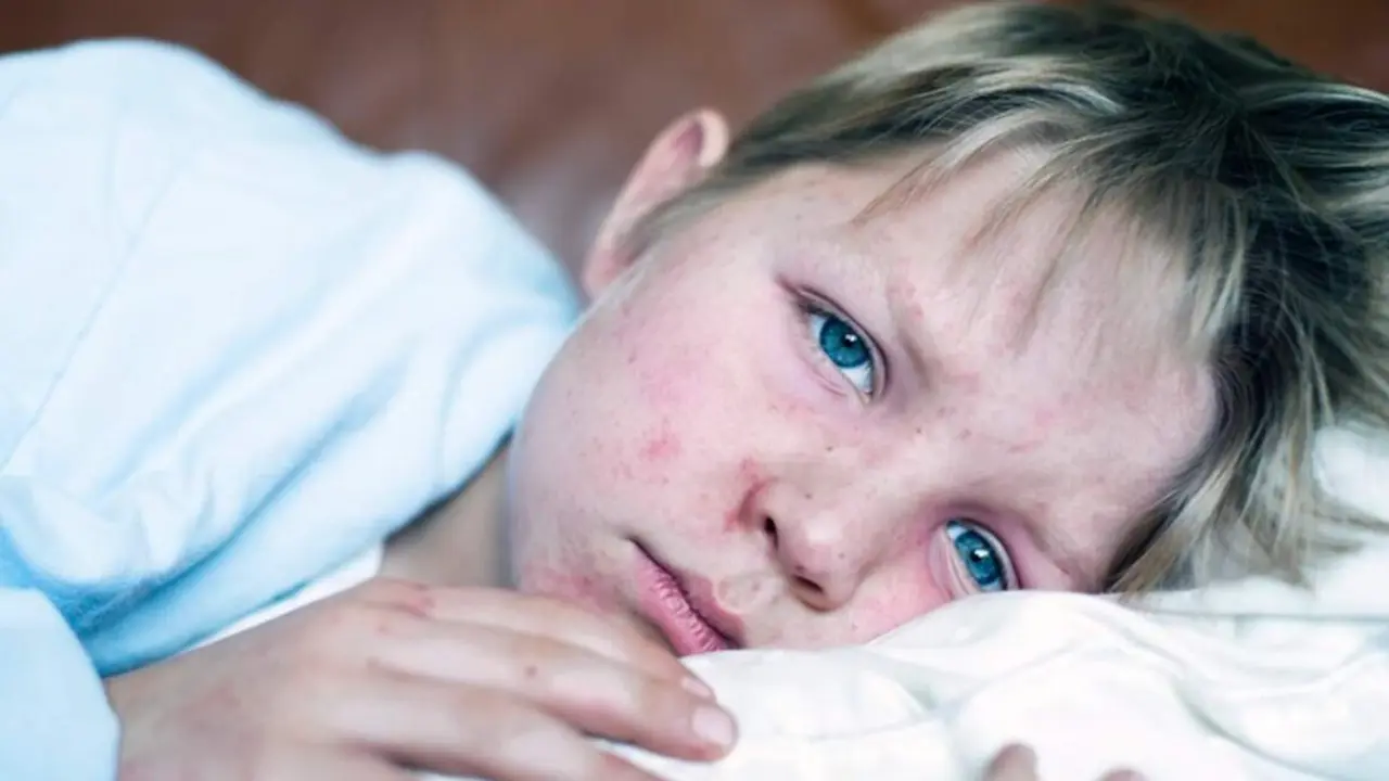  Archivo - Sarampi&oacute;n. - CHRISTOPHER BADZIOCH / CHBD - Archivo 