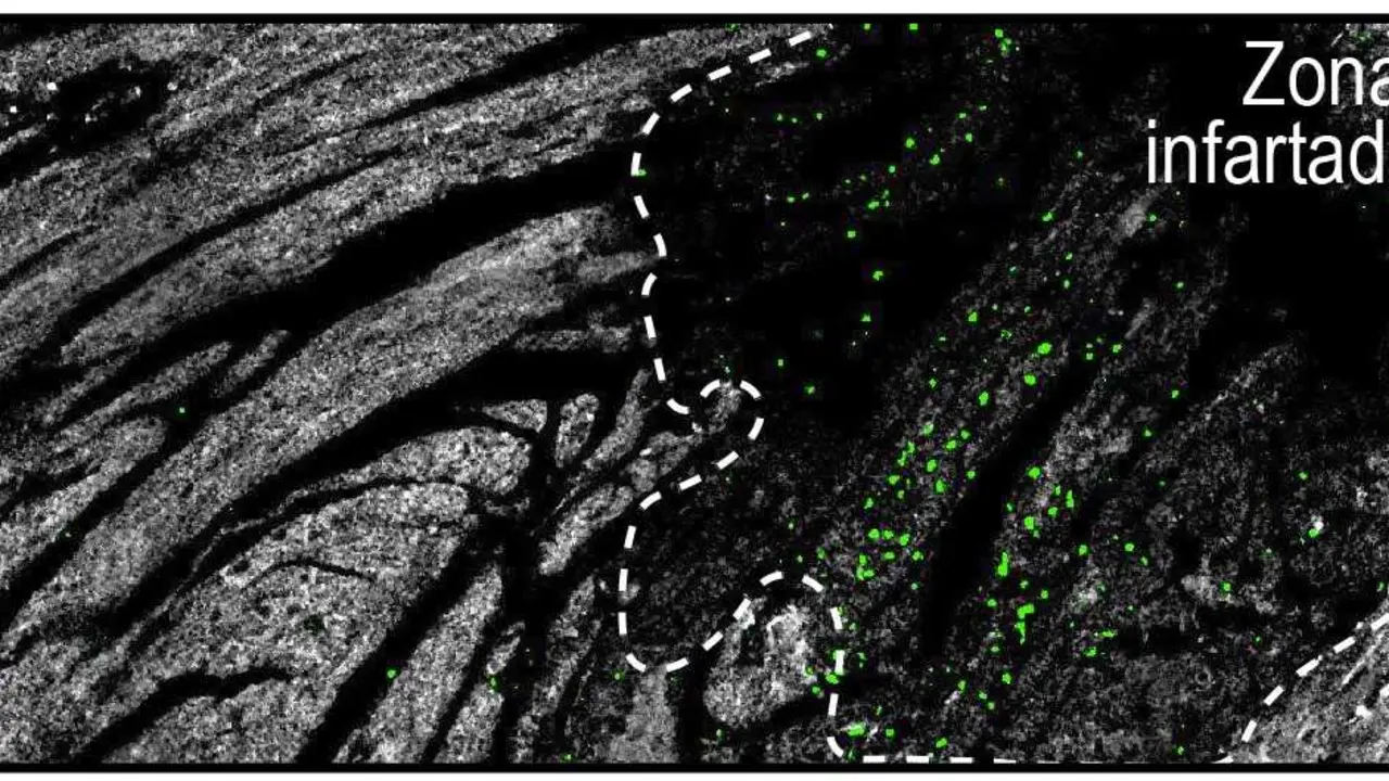 
<p>    MADRID, 12 (EUROPA PRESS)</p>
<p>   Un equipo de cient&iacute;ficos del Centro Nacional de Investigaciones Cardiovasculares (CNIC) ha logrado explicar porqu&eacute; los infartos que se producen en la noche son menos severos que los diurnos, y tiene que ver con la variaci&oacute;n a lo largo del d&iacute;a de la agresividad de los neutr&oacute;filos, un tipo de gl&oacute;bulo blanco.</p>
<p>   El trabajo, publicado en la revista 'Journal of Experimental Medicine', muestra la existencia de un mecanismo circadiano dentro de los neutr&oacute;filos que hace fluctuar su actividad destructiva, y determina el grado de da&ntilde;o que provocan en el coraz&oacute;n tras un infarto.</p>
<p>   Debido a que los seres humanos son una especie diurna, existe una mayor probabilidad de exponerse a infecciones durante esta etapa del d&iacute;a, motivo por el que el sistema inmunol&oacute;gico ajusta sus picos de actividad al ritmo circadiano, aunque esta respuesta puede en ocasiones volverse perjudicial en casos de estr&eacute;s como los infartos de miocardio, en los que el sistema inmunitario puede causar da&ntilde;os colaterales severos en los tejidos.</p>
<p>   "Por la noche, los neutr&oacute;filos se dirigen a la zona da&ntilde;ada respetando el tejido sano, que as&iacute; no se ve afectado. Es durante el d&iacute;a cuando pierden esta direccionalidad y generan m&aacute;s da&ntilde;o en el tejido circundante", ha explicado la primera autora del estudio, la doctora Alejandra Aroca-Crevill&eacute;n.</p>
<p>   Durante la investigaci&oacute;n tambi&eacute;n se ha desarrollado una estrategia farmacol&oacute;gica en modelos experimentales para bloquear este reloj molecular, lo que permite mantenerlas en un "estado nocturno" y reducir su potencial da&ntilde;ino durante el infarto.</p>
<p>   "Nos sorprendi&oacute; comprobar (...) que el bloqueo del reloj circadiano de los neutr&oacute;filos no solo protege el coraz&oacute;n, sino que tambi&eacute;n mejora la respuesta frente a algunos microbios e incluso reduce las embolias asociadas a la anemia falciforme", ha a&ntilde;adido la primera autora de la investigaci&oacute;n.</p>
<p>   Por su parte, el jefe del grupo investigador, el doctor Andr&eacute;s Hidalgo, ha detallado que "el compuesto imita un factor que el cuerpo produce principalmente durante la noche", y que este factor "enga&ntilde;a" a los neutr&oacute;filos para hacerles creer que "es de noche", lo que disminuye su actividad t&oacute;xica.</p>
<p>   Su desarrollo se ha llevado a cabo en colaboraci&oacute;n con el l&iacute;der del grupo de Investigaci&oacute;n Cardiovascular Traslacional Multidisciplinaria en el (CNIC), el doctor H&eacute;ctor Bueno, tras analizar los datos de miles de pacientes del Hospital 12 de Octubre.</p>
<p>   Este trabajo constituye una de las primeras estrategias en aprovechar los ritmos circadianos del sistema inmunitario para modular la inflamaci&oacute;n, y sin comprometer la defensa frente a infecciones, lo que "abre la puerta" a nuevas terapias basadas en la biolog&iacute;a del tiempo, que tienen el potencial de proteger el coraz&oacute;n y otros &oacute;rganos del da&ntilde;o inflamatorio sin debilitar las defensas naturales del organismo.</p>
<p>   Adem&aacute;s, ha sido financiado por la Fundaci&oacute;n La Caixa; los Institutos Nacional de Salud de Estados Unidos; el Ministerio de Ciencia, Innovaci&oacute;n y Universidades (MICIU); el Consejo de Becas de China; la ANR PRC; la Fundaci&oacute;n para la Investigaci&oacute;n M&eacute;dica de Francia (FRM); la red transatl&aacute;ntica de excelencia Leducq sobre efectos circadianos en ictus; la Sociedad Espa&ntilde;ola de Cardiolog&iacute;a; y ha recibido el apoyo de AstraZeneca, Boehringer Ingelheim y Janssen.</p>
      