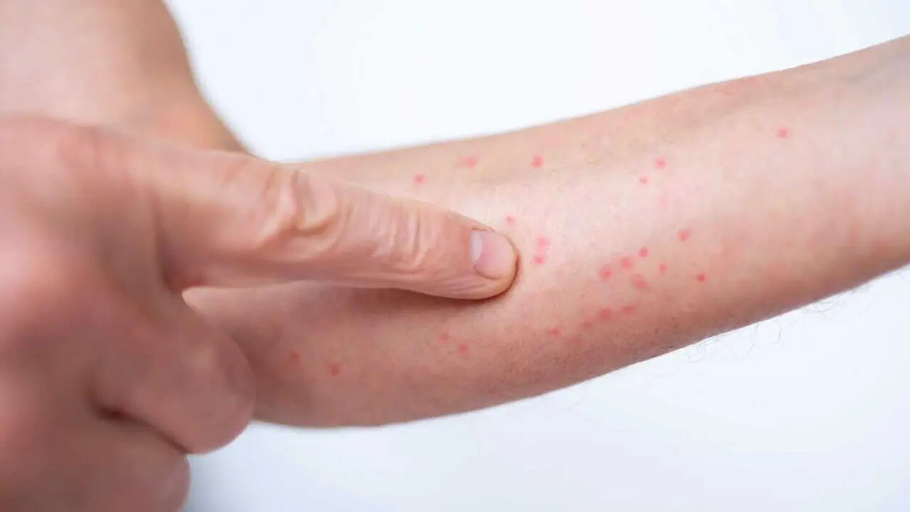 Inflamed skin with red spots on man's arm, symptoms conditions like chronic psoriasis, dermatitis or allergic response, topical medication