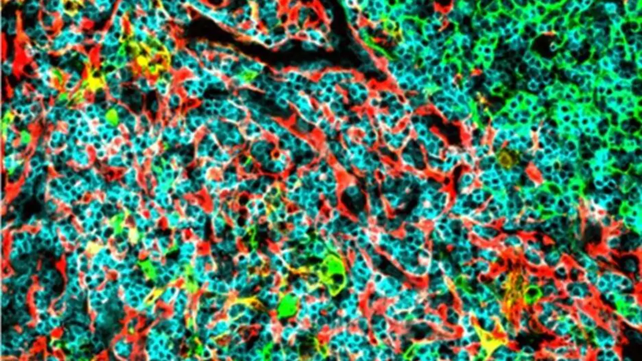 Identifican dos mol&eacute;culas del organismo que podr&iacute;an ayudar a frenar el crecimiento de un tipo de leucemia muy agresiva