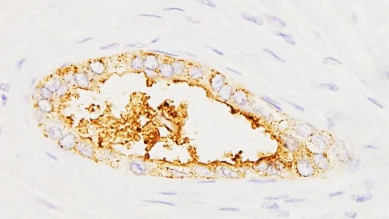 Investigadores espa&ntilde;oles crean un prototipo de test para detectar c&aacute;ncer de p&aacute;ncreas 'en minutos' con muestras de sangre