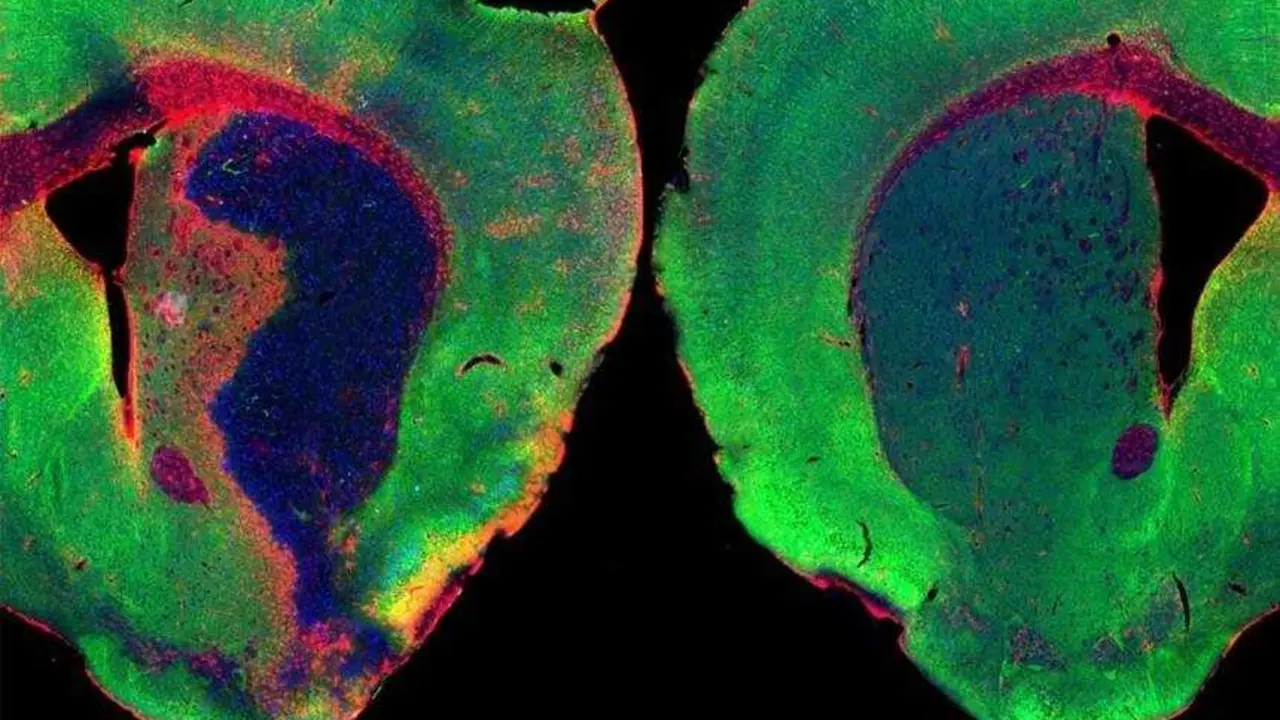 Un estudio liderado por el CSIC revela que una mol&eacute;cula del organismo reduce inflamaci&oacute;n y da&ntilde;o cerebral tras ictus