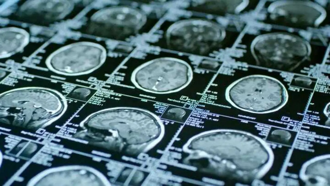 Archivo - Im&aacute;genes de resonancia magn&eacute;tica de un cerebro