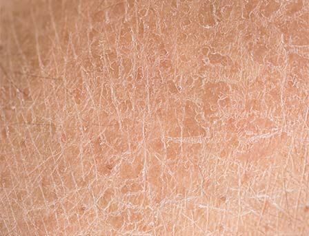 Piel seca. Pinterest.