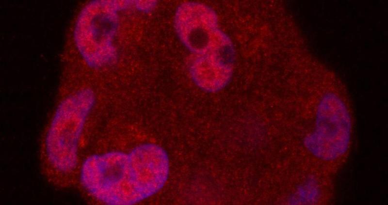 ProstateCancerCells-androgen-receptor-in-dark-red-Washington-University-School-of-Medicine-in-St-Louis