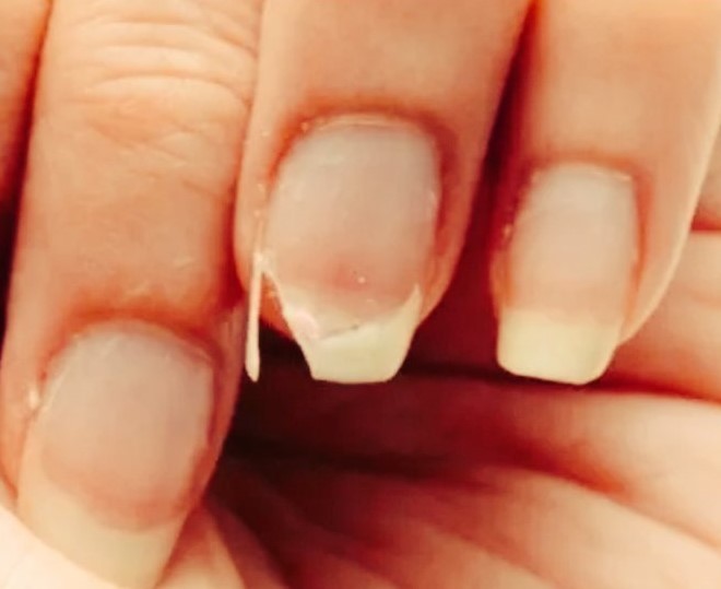 uñas quebradizas